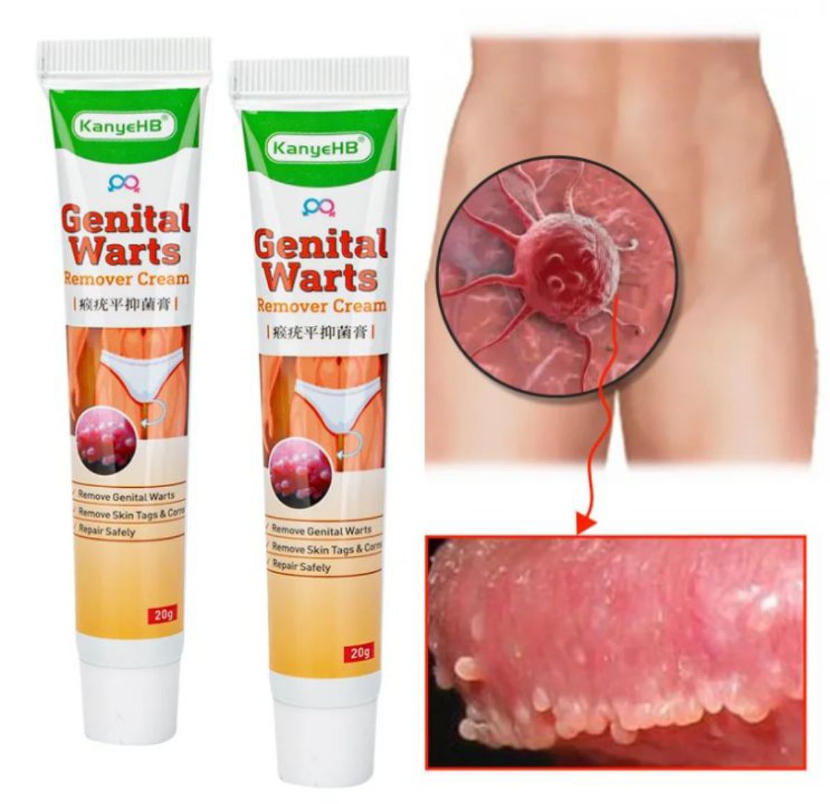 Crème anti-verrues génitales d&rsquo;herpès condylomes